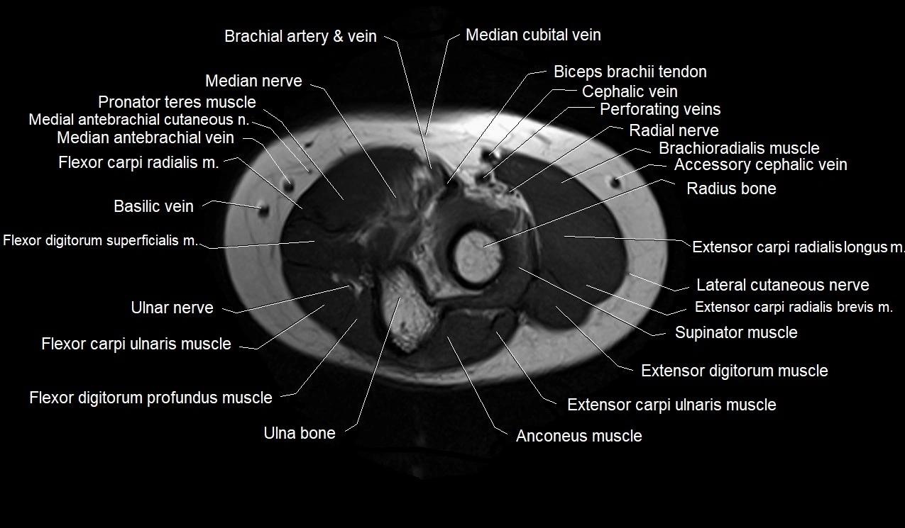 MRI 3T forearm axial cross sectional anatomy image 9.webp